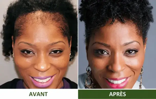Avant et après d'une cliente Varosia