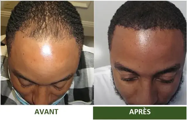 Avant et après d'une cliente Varosia