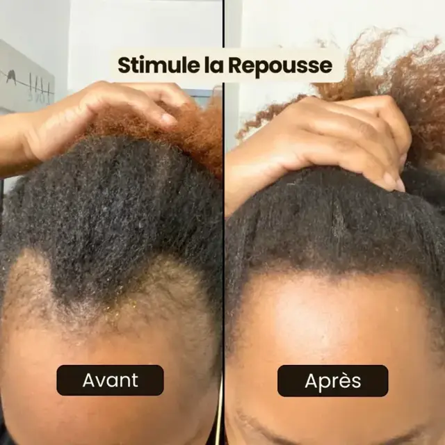 Avant et après d'une cliente Varosia